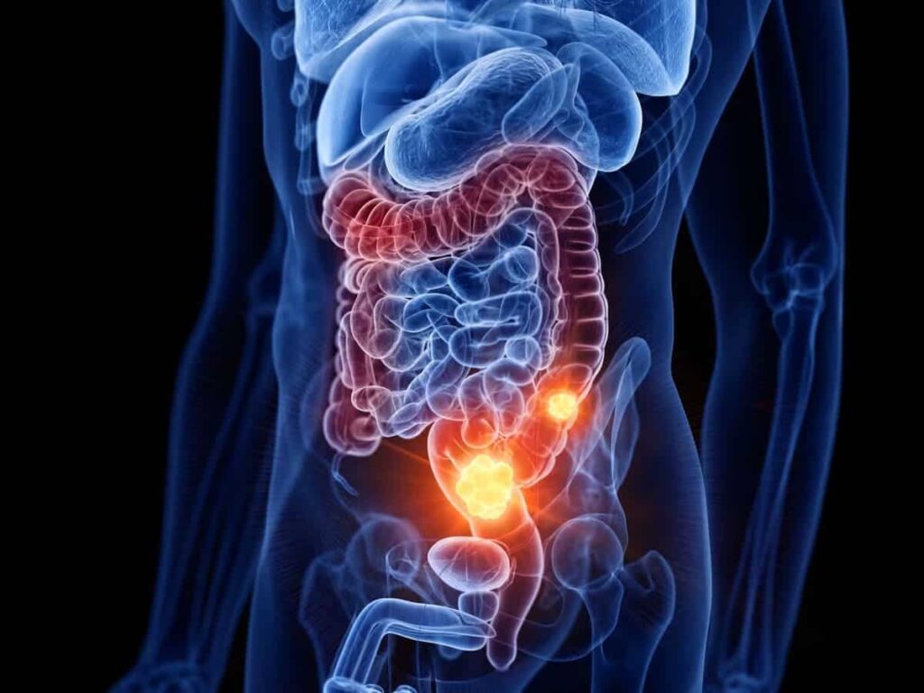 Colon cancer: lifestyle changes that could make all the difference, according to science – Futura-Sciences