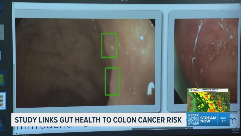 Study finds diet and lifestyle may shape colon cancer risk through gut microbes